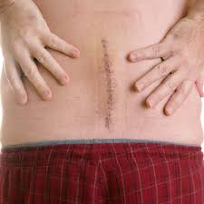 sciatic nerve back pain