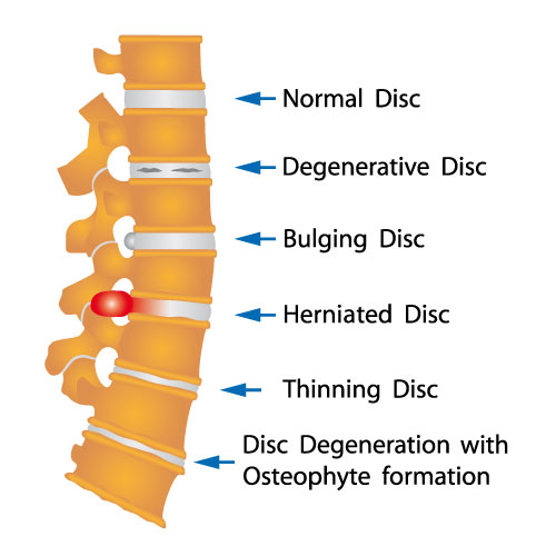 Slipped Disc Advanced Pain Centres